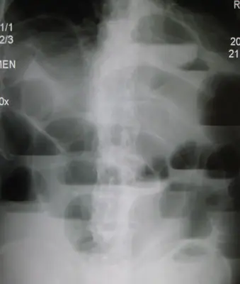 Radiograph from the case bank: Bowel obstruction