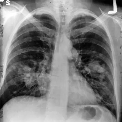 Radiograph from the case bank: Lung cancer (mass)