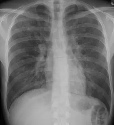 Radiograph from the case bank: Pneumocystis pneumonia (PCP)