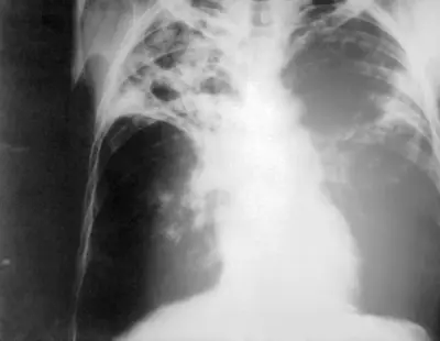 Radiograph from the case bank: Pulmonary tuberculosis