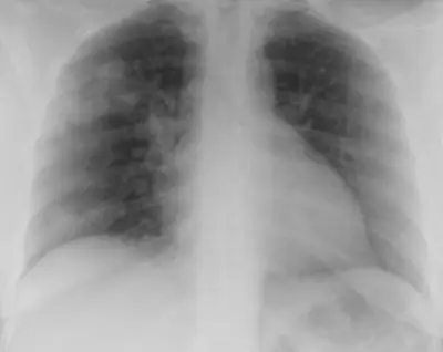 Radiograph from the case bank: COVID-19 pneumonia