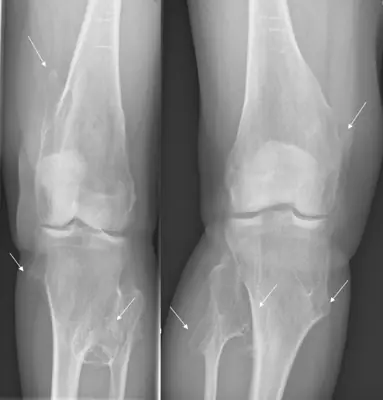 Radiograph from the case bank: Osteochondroma (exostosis)