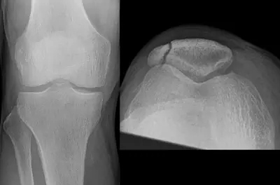 Radiograph from the case bank: Patellar fracture
