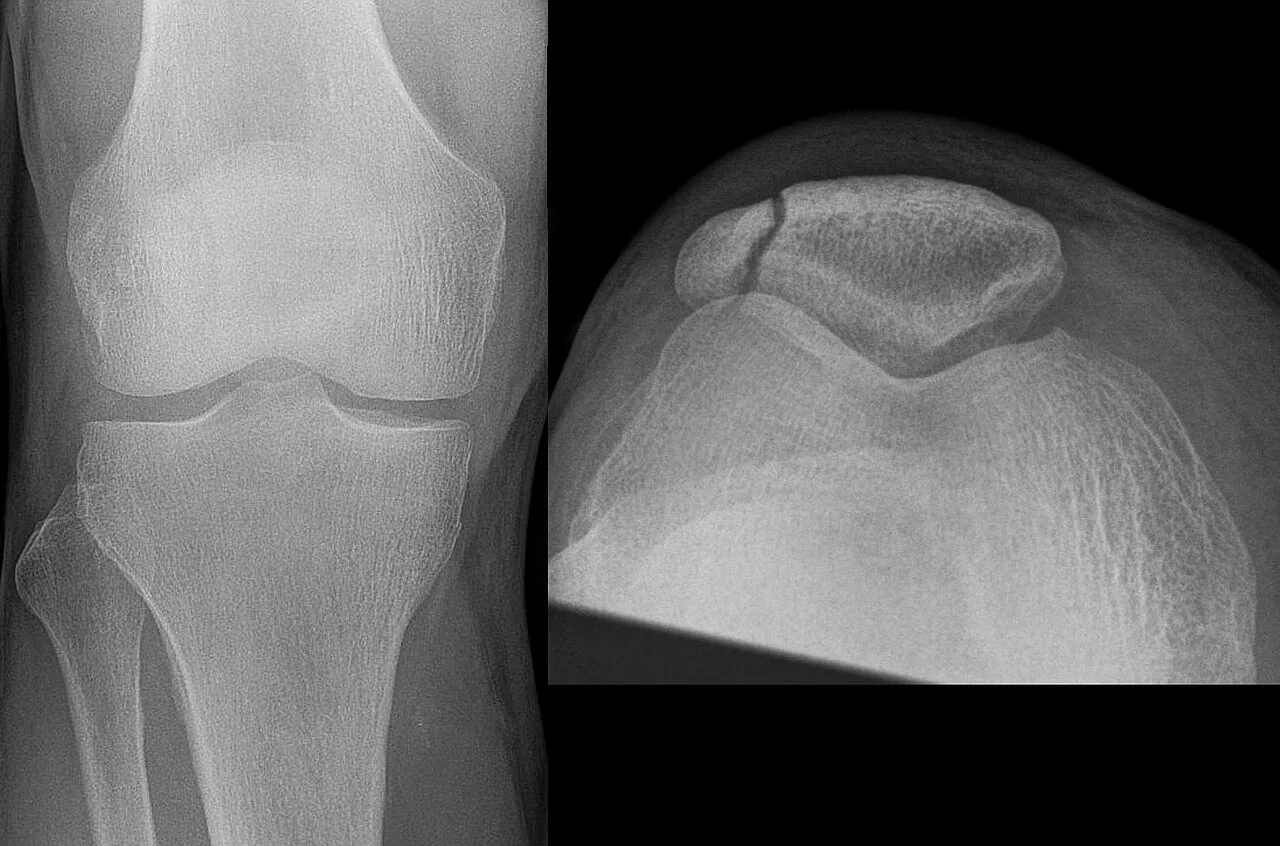 Lower limb radiograph for self-assessment