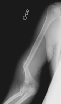 Radiograph from the case bank: Humeral shaft fracture