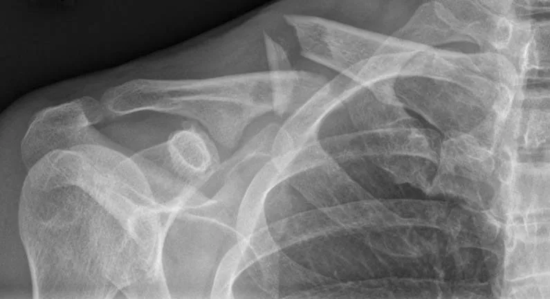 Upper limb radiograph for self-assessment