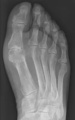 Radiograph from the case bank: Gout