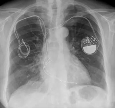 Radiograph from the case bank: Cardiac pacemaker