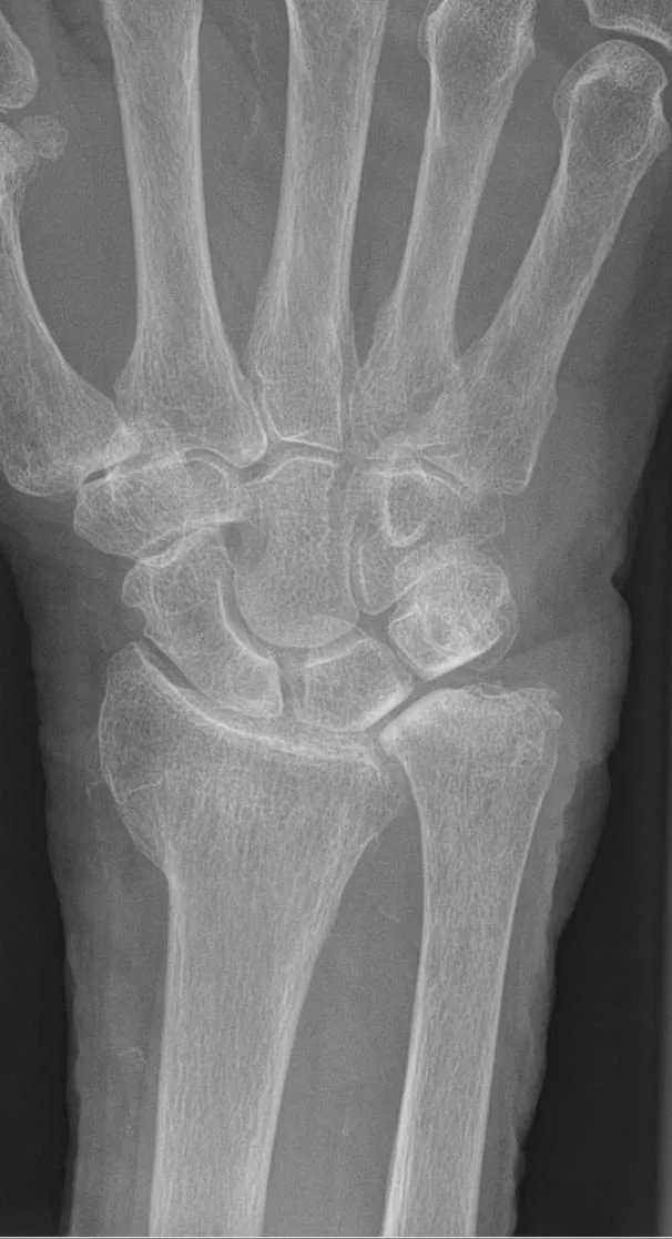Upper limb radiograph for self-assessment