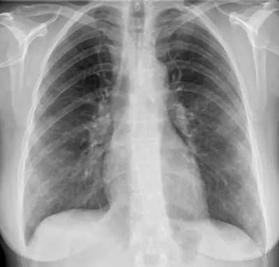 Radiograph from the case bank: COVID-19 pneumonia