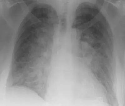 Radiograph from the case bank: Pulmonary oedema (heart failure)