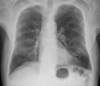 Radiograph from the case bank: Emphysema / COPD (hyperinflation)