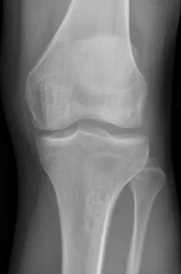 Radiograph from the case bank: Non-ossifying fibroma