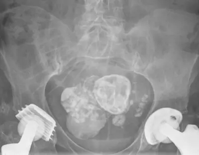 Radiograph from the case bank: Calcified uterine fibroid