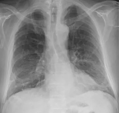 Radiograph from the case bank: COVID-19 pneumonia