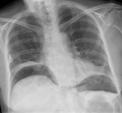 Radiograph from the case bank: Pneumoperitoneum (free intraperitoneal gas)