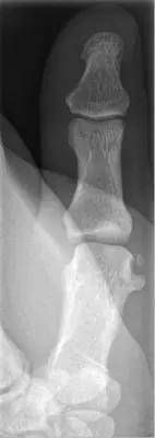 Radiograph from the case bank: Osteochondroma (exostosis)