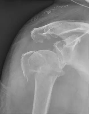 Radiograph from the case bank: Proximal humerus fracture