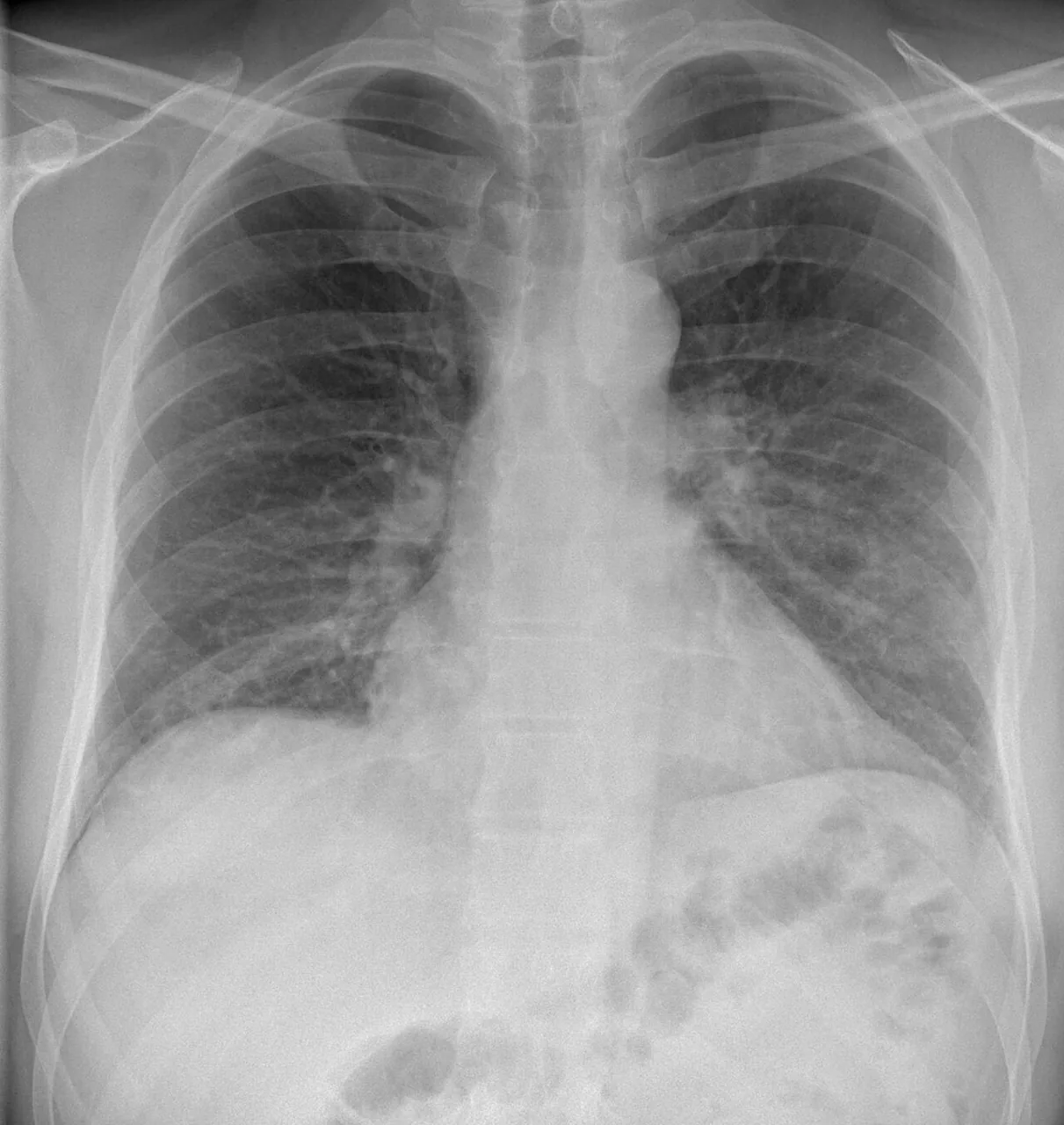 Chest radiograph for self-assessment