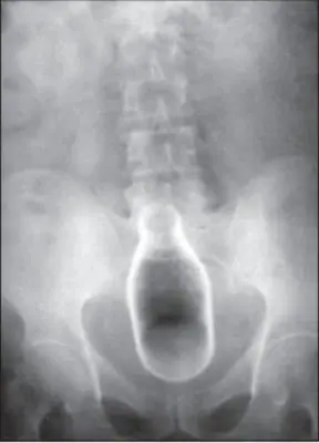 Radiograph from the case bank: Foreign body (ingested or inserted)