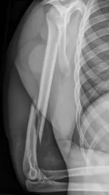 Radiograph from the case bank: Humeral shaft fracture