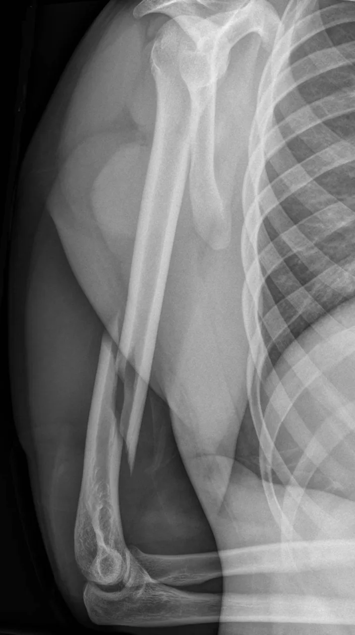 Upper limb radiograph for self-assessment