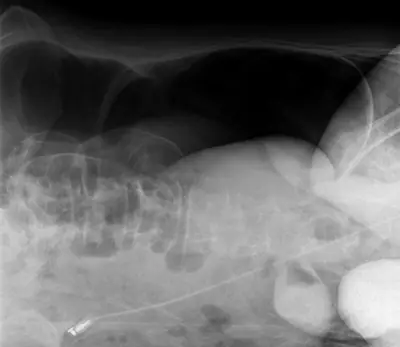 Radiograph from the case bank: Pneumoperitoneum (free intraperitoneal gas)