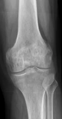 Radiograph from the case bank: Osteoporosis