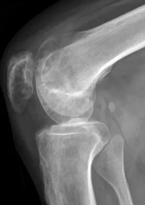 Radiograph from the case bank: Osteoporosis