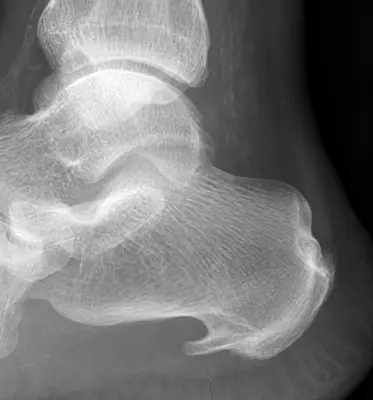 Radiograph from the case bank: Calcaneal spur