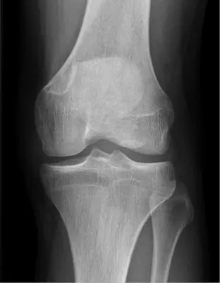 Radiograph from the case bank: Non-ossifying fibroma