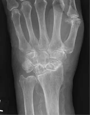 Radiograph from the case bank: Scaphoid fracture
