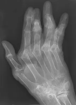 Radiograph from the case bank: Rheumatoid arthritis
