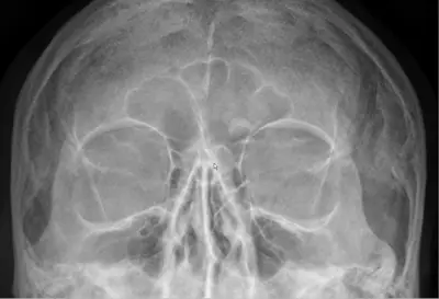Radiograph from the case bank: Osteoma