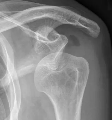 Radiograph from the case bank: Shoulder (glenohumeral) dislocation