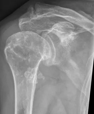 Radiograph from the case bank: Synovial chondromatosis
