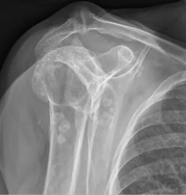 Radiograph from the case bank: Synovial chondromatosis