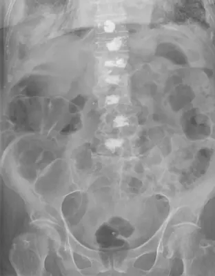 Radiograph from the case bank: Pneumoperitoneum (free intraperitoneal gas)