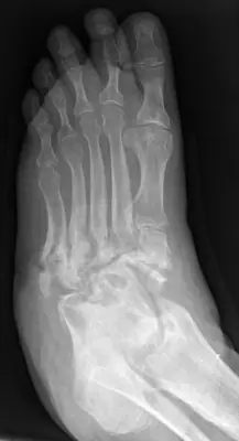 Radiograph from the case bank: Neuropathic (Charcot) arthropathy
