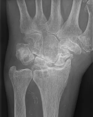 Radiograph from the case bank: Osteoarthritis