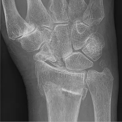 Radiograph from the case bank: Osteoarthritis