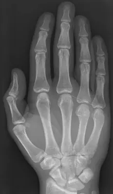 Radiograph from the case bank: Metacarpal fracture