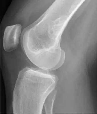 Radiograph from the case bank: Non-ossifying fibroma