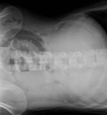 Radiograph from the case bank: Bowel obstruction