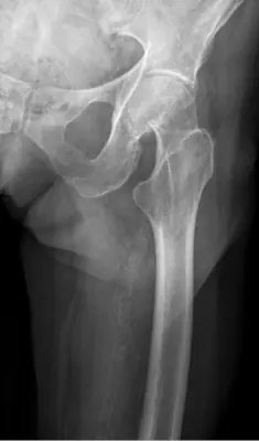 Radiograph from the case bank: Hip (proximal femoral) fracture