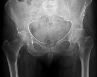 Radiograph from the case bank: Hip (proximal femoral) fracture