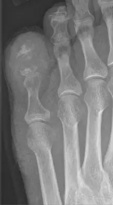 Radiograph from the case bank: Gout