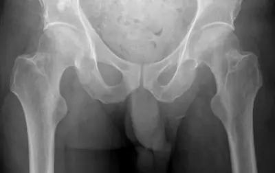 Radiograph from the case bank: Hip (proximal femoral) fracture