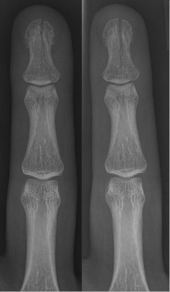 Upper limb radiograph for self-assessment