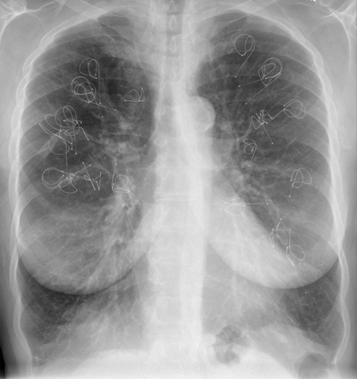 Chest radiograph for self-assessment